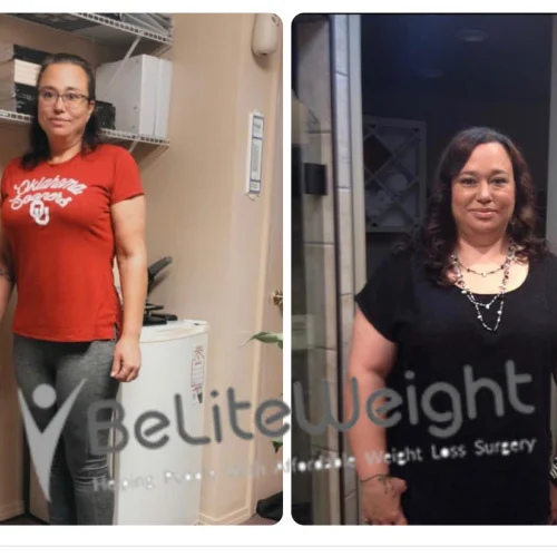 Weight Loss Surgery Before And After